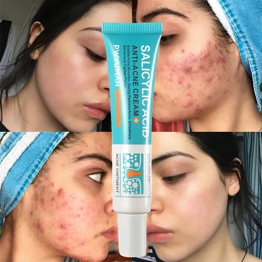 Secativo de Espinhas em Gel - Fórmula Asiática com Ácido Salicílico (Cópia)