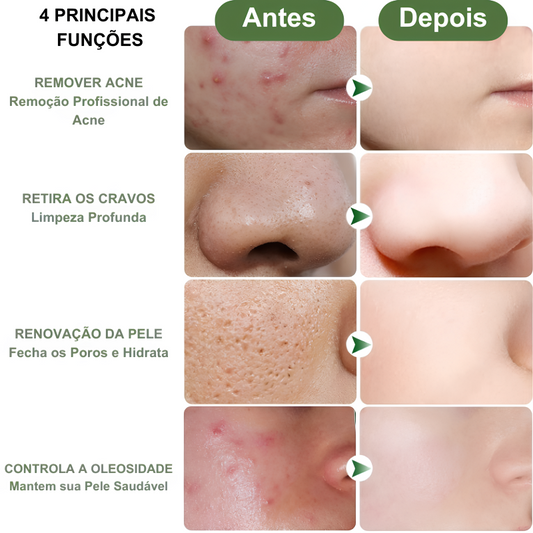 Hidratante Facial que Remove Acnes e Renova a Pele
